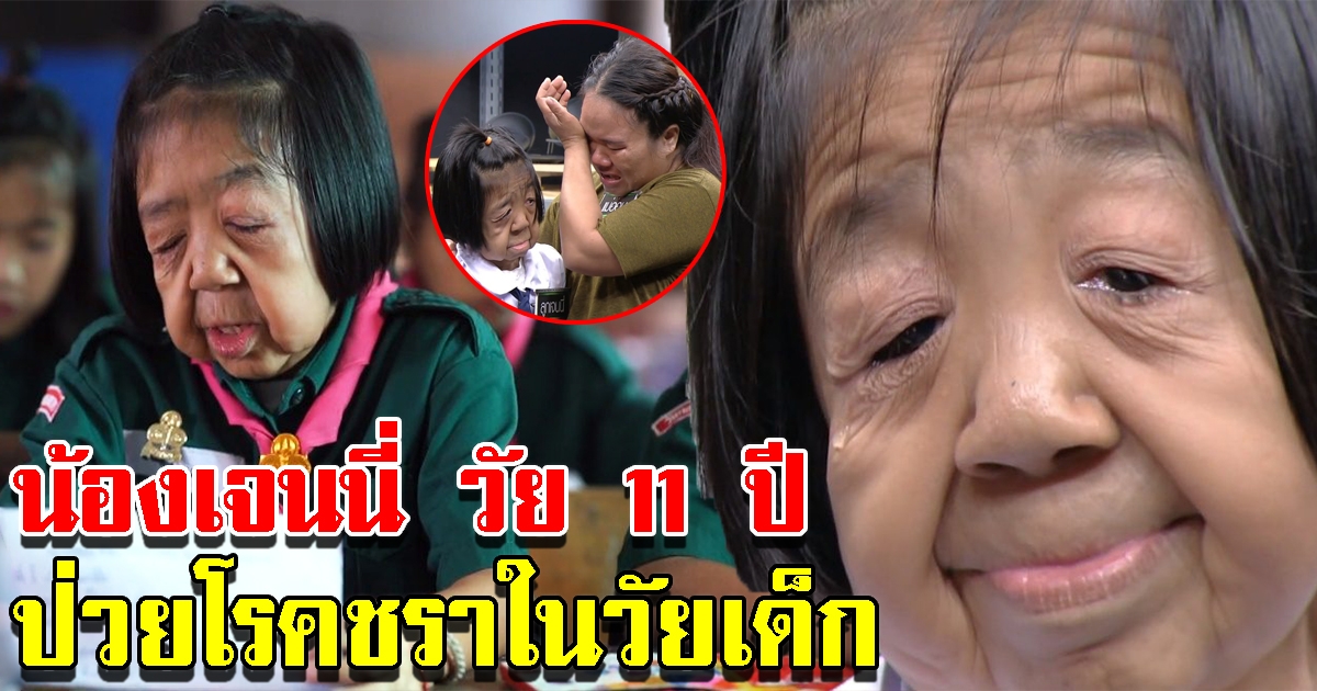 เปิดชีวิต น้องเจนนี่ เด็กหญิงวัย 11 ปี ป่วยเป็นโรคชราในวัยเด็ก